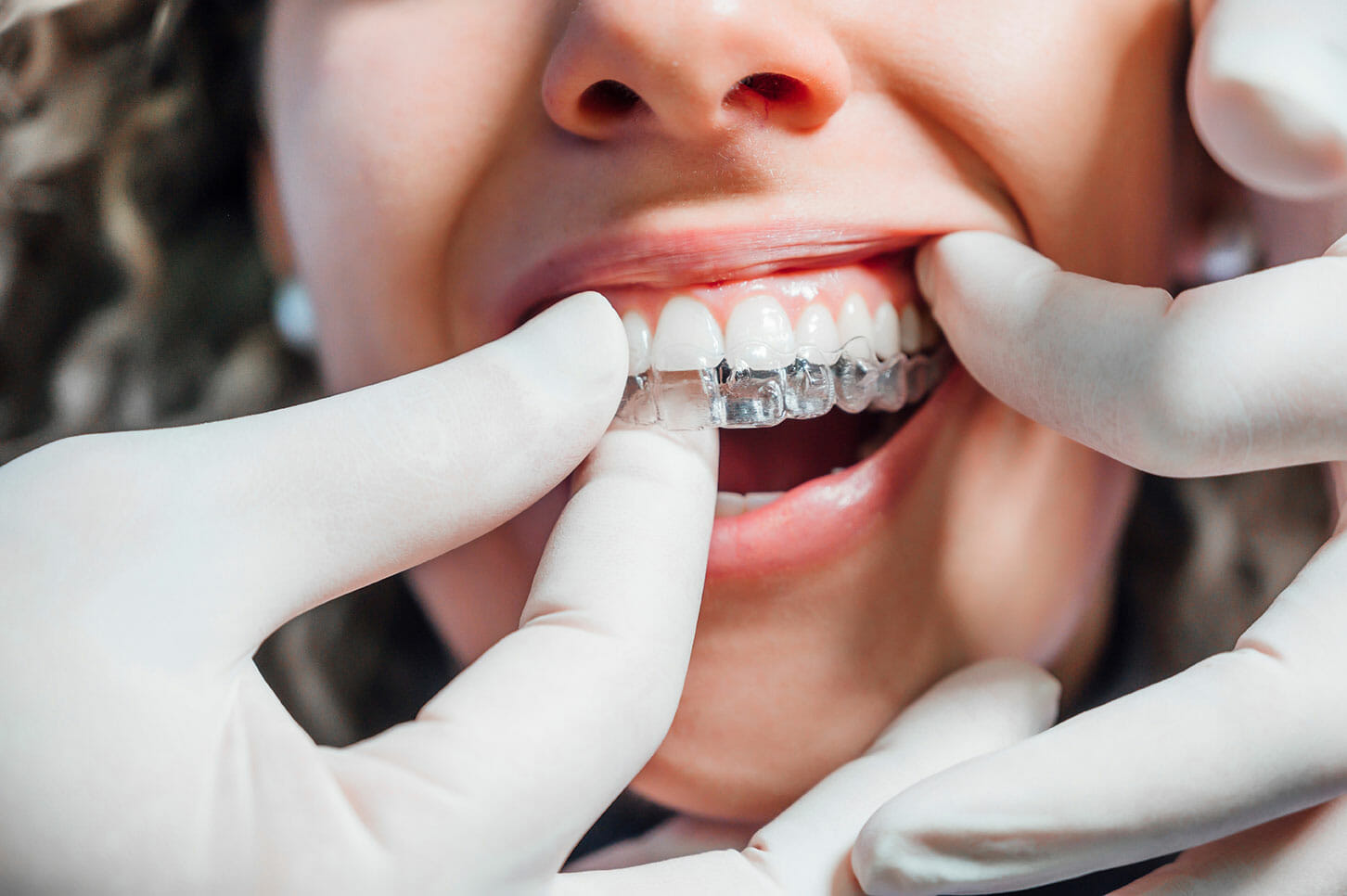 Dentist Putting Invisalign Retainer in Patient's Mouth