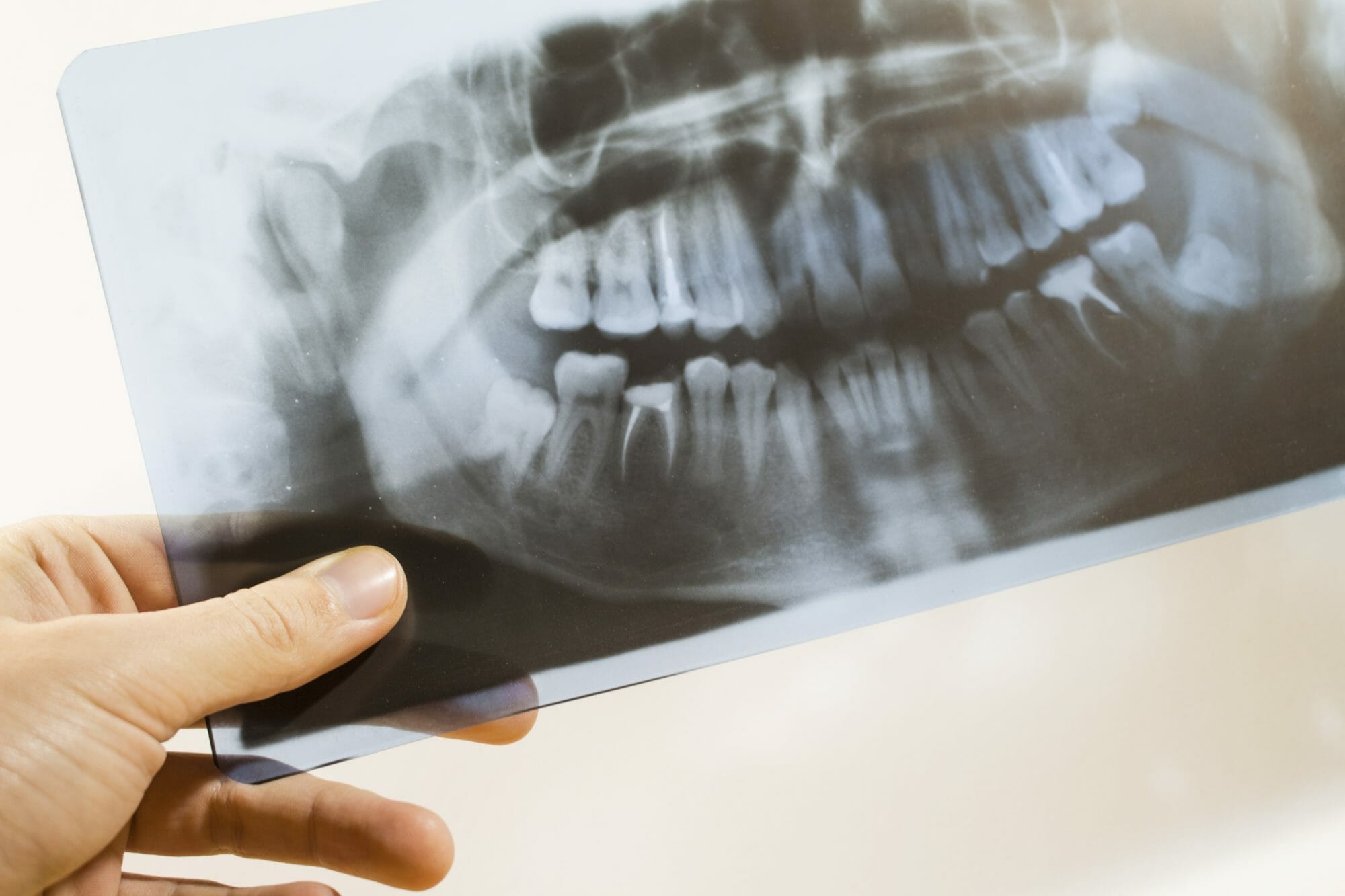 Hand holding an x-ray of a dental patient's mouth